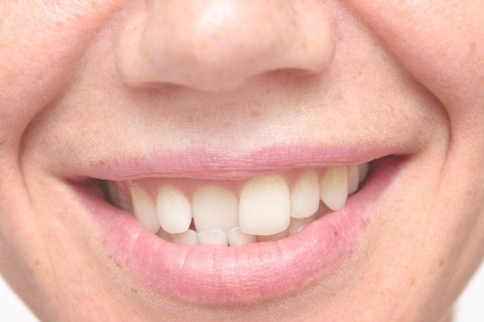 crooked teeth treatment in Indianapolis, Indiana
