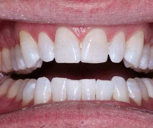 Dental results at North Meridian Dental Excellence