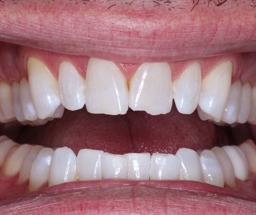 Dental results at North Meridian Dental Excellence