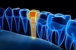 Indianapolis, Indiana affordable dental implants
