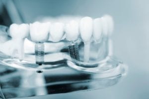 affordable dental implants in indianapolis, indiana