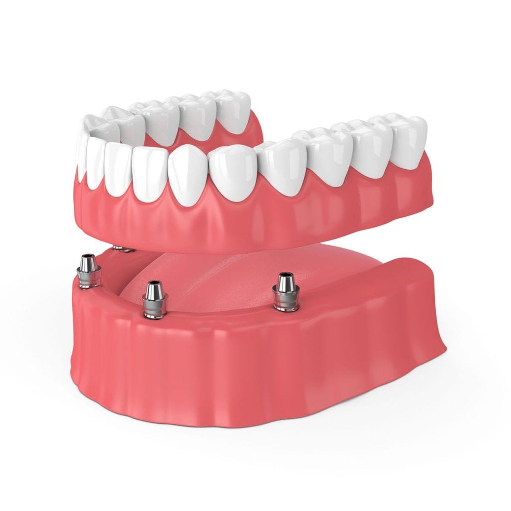 dental implants dentist carmel in