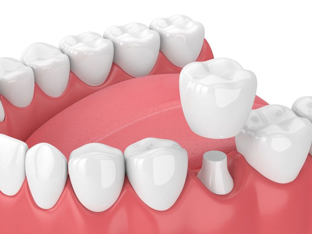 dental crown procedure in Indianapolis Indiana