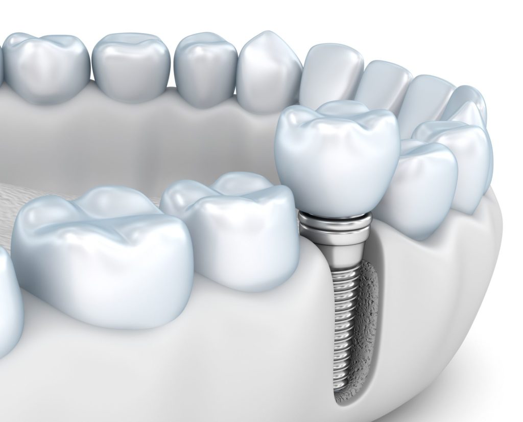 implant dentistry in Indianapolis Indiana
