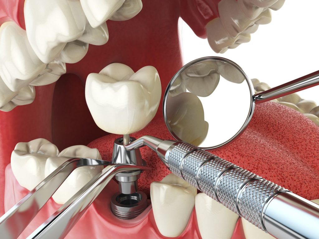 implant dentistry treatment expectations