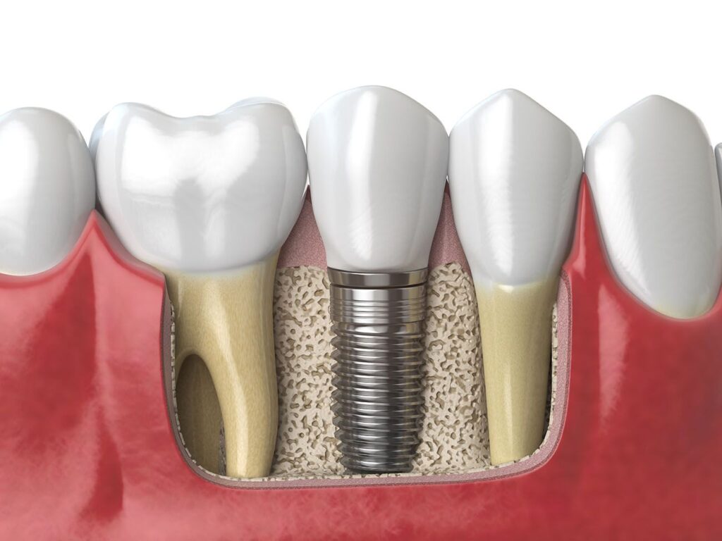 Choose Durability with Dental Implants