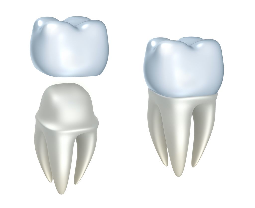 Know Your Dental Crown Procedure