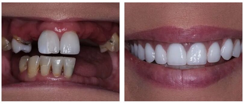 Happy patient before and after dentures at North Meridian Dental Excellence
