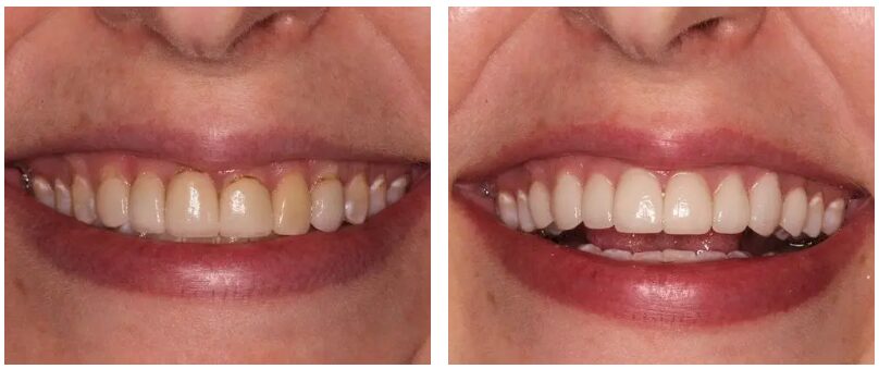 Happy patient before and after porcelain veneers at North Meridian Dental Excellence